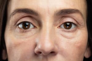Close-up of middle-aged woman with tired eyes, concept of aging, eye care, and cosmetic rejuvenation